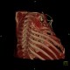 Thoracoplasty, VRT: CT - Computed tomography